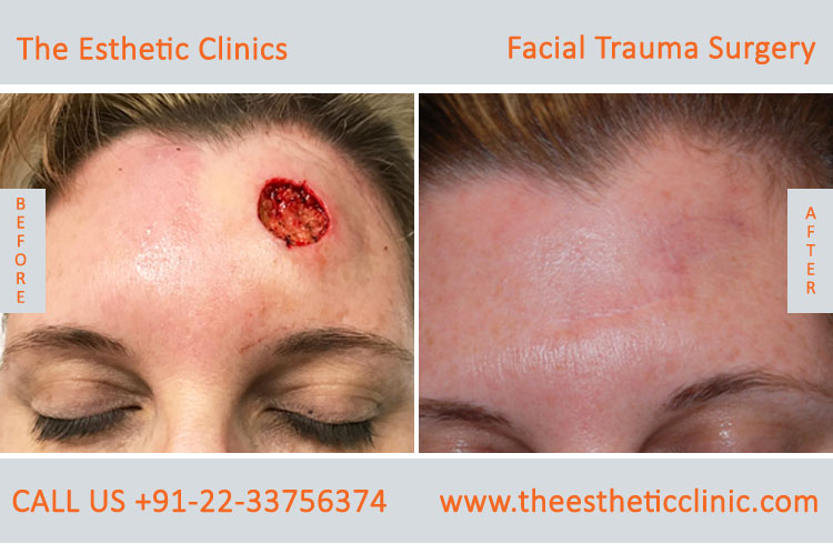 Facial Trauma surgery, Maxillofacial Reconstruction Surgery before after photos in mumbai india (2)